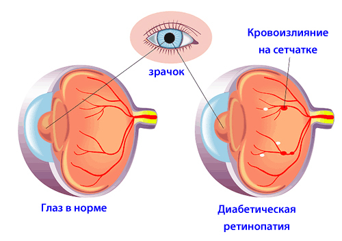 Диабетическая ретинопатия: причины возникновения, клинические проявления, диагностика и тактика лечения