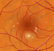 Диабетическая ретинопатия: причины возникновения, клинические проявления, диагностика и тактика лечения