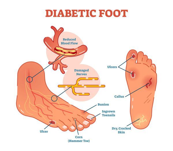Диабетическая стопа: симптомы и лечение, стадии, уход за ногами