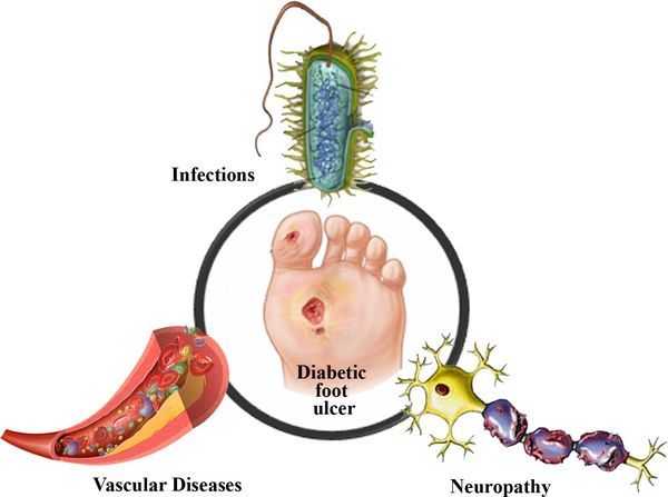Диабетическая стопа: симптомы и лечение, стадии, уход за ногами