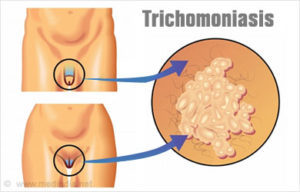 Диагностика трихомониаза, влагалищной трихомонады: что за заболевание, виды анализов у мужчин и женщин, профилактика