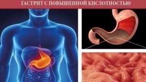 Диета при гастрите с повышенной кислотностью: правила питания и особенности рациона при болезни желудка