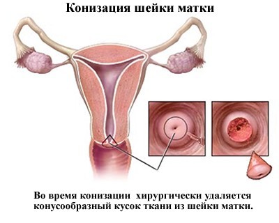 Дисплазия шейки матки: причины, симптомы, стадии, диагностика и лечение