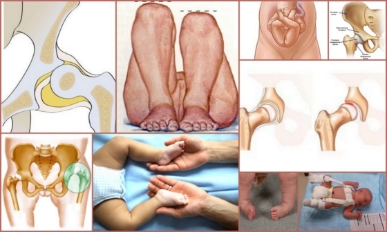 Дисплазия тазобедренного сустава: основные причины, степени патологии, характерные симптомы, способы лечения