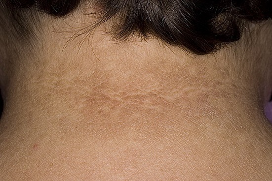 Дистрофия кожи лица и тела: причины, симптомы, диагностика, лечение, фото