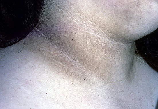 Дистрофия кожи лица и тела: причины, симптомы, диагностика, лечение, фото
