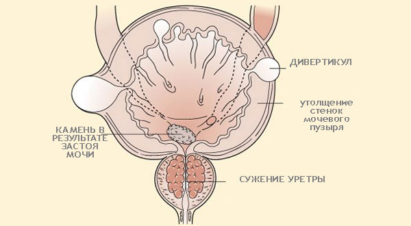 Дивертикул мочевого пузыря: что это такое, причины появления, симптомы и лечение