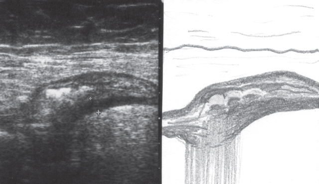Дивертикулез кишечника: ирригоскопия и МРТ для определения заболевания