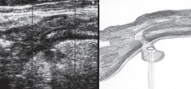 Дивертикулез кишечника: ирригоскопия и МРТ для определения заболевания