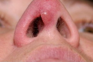 Доброкачественные опухоли полости носа: что это такое, виды новообразований, основные симптомы и методы лечения