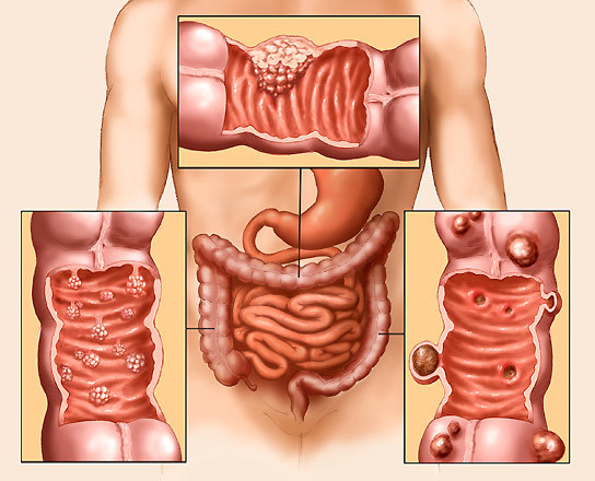 Доброкачественные опухоли толстого кишечника: механизм развития, сопутствующие симптомы, методы обследования и лечения