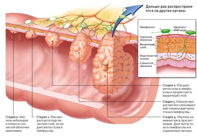 Доброкачественные опухоли толстого кишечника: механизм развития, сопутствующие симптомы, методы обследования и лечения