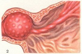 Доброкачественные опухоли желудка: причины развития, клинические признаки, принципы лечения и возможные осложнения