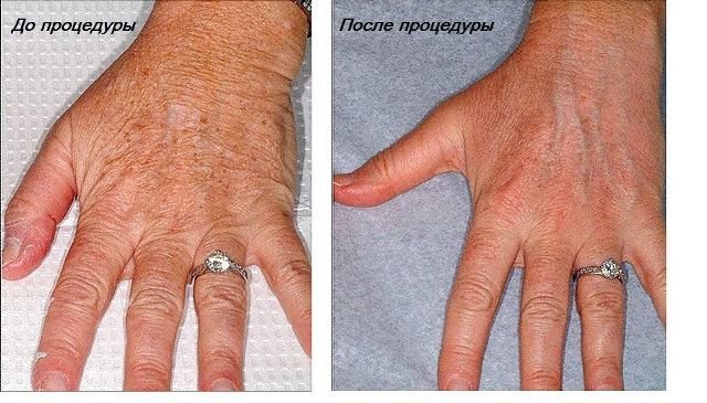Дряблость кожи рук: провоцирующие факторы, методы коррекции, показания и противопоказания к проведению