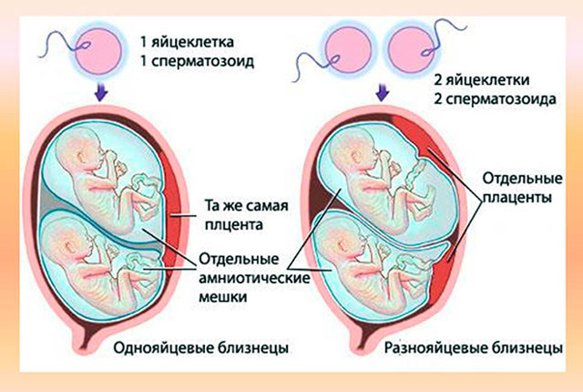 Двойни и близнецы (многоплодная беременность) при ЭКО: какие бывают двойни?