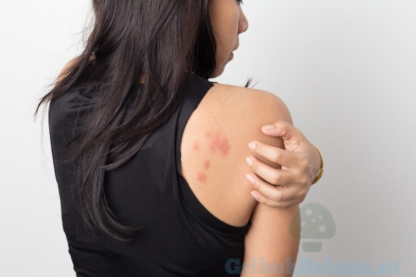 Эксфолиативный дерматит (эритема и шелушение кожи): что является причиной проявления болезни?