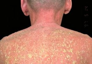 Эксфолиативный дерматит (эритема и шелушение кожи): что является причиной проявления болезни?