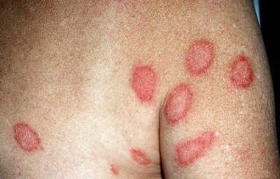 Экзема (высыпание на коже): стадии, как проявляется у взрослых, почему усиливается сыпь?