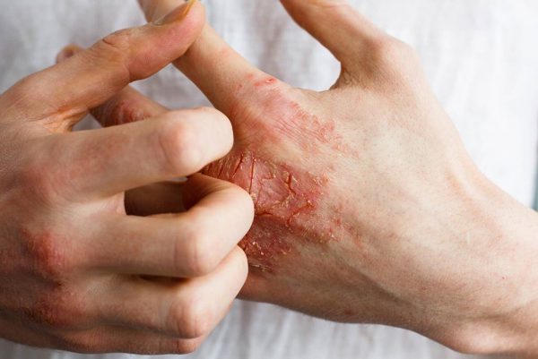 Экзема (высыпание на коже): стадии, как проявляется у взрослых, почему усиливается сыпь?