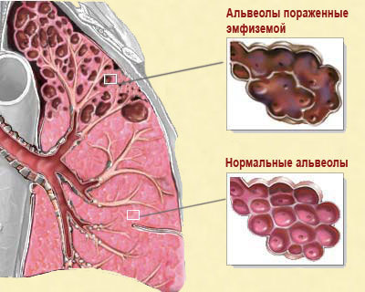 Эмфизема легких: симптомы и причины заболевания дыхательных путей