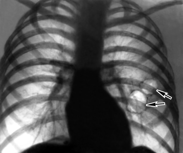 Эмфизема легких: симптомы и причины заболевания дыхательных путей
