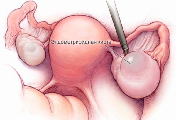 Эндометриоидная киста яичника: причины появления образования в виде пузыря