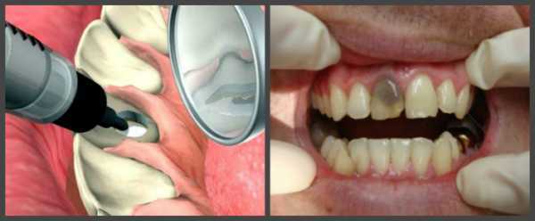 Эндоотбеливание зубов — внутрикоронковое отбеливание: как работает и какие используются препараты