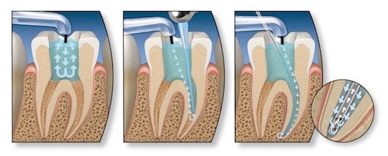 Эндоотбеливание зубов — внутрикоронковое отбеливание: как работает и какие используются препараты