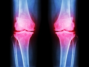 Эностоз бедренной кости: описание патологии и современные способы терапии заболевания