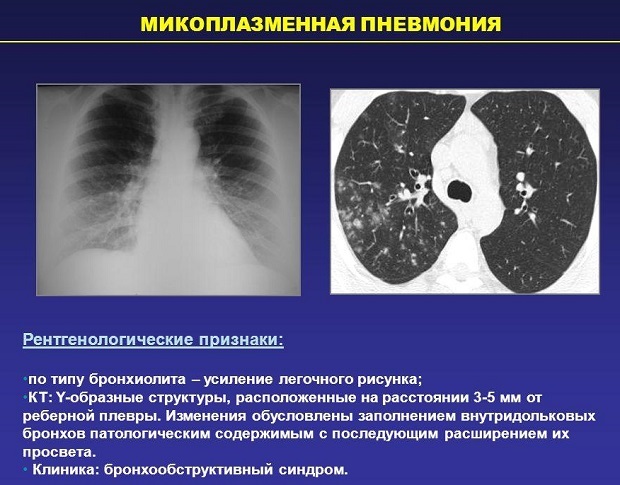 Эпидемия пневмонии 2019: как проявляется и лечение микоплазменной болезни у детей и взрослых