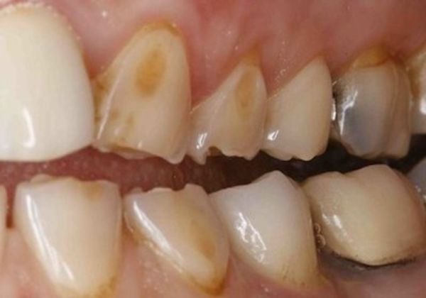 Эрозия зубной эмали — причины кариозного и некариозного поражения