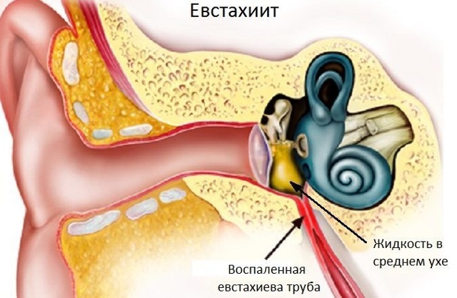 Евстахиит: симптомы и лечение тубоотита, признаки хронического и острого евстахиита, как лечить евстахиит
