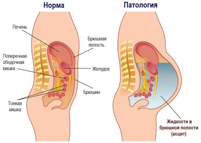 Фиброма яичника: причины образования, симптомы, методы диагностики и лечения