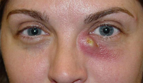 Флегмона глаза — причины, симптомы флегмоны глазницы, века, слезного мешка, диагностика и лечение