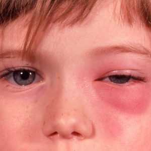 Флегмона глаза — причины, симптомы флегмоны глазницы, века, слезного мешка, диагностика и лечение