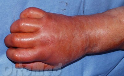 Флегмона кисти руки: причины воспаления, методы лечения и профилактики