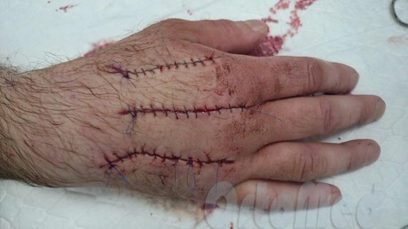 Флегмона кисти руки: причины воспаления, методы лечения и профилактики