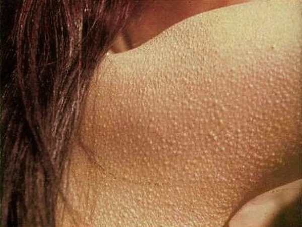 Фолликулярный гиперкератоз: лечение и причины гусиной кожи, как избавиться от неприятного явления?