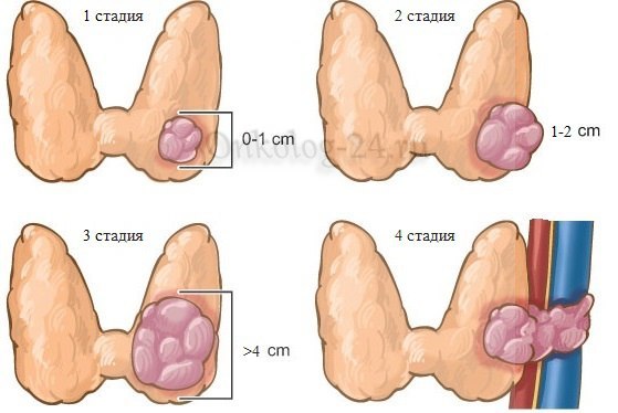 Фолликулярный рак щитовидной железы: провоцирующие факторы, клинические признаки, способы лечения и возможные осложнения
