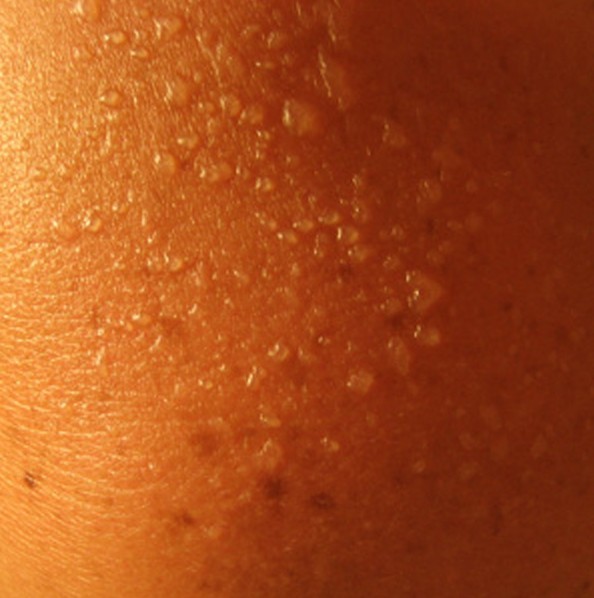 Фотодерматит на лице и теле: причины, симптомы аллергии