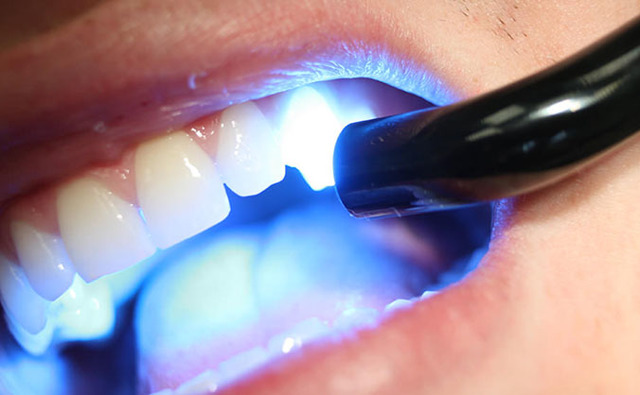Фотоотбеливание зубов: что это, подготовка к процедуре