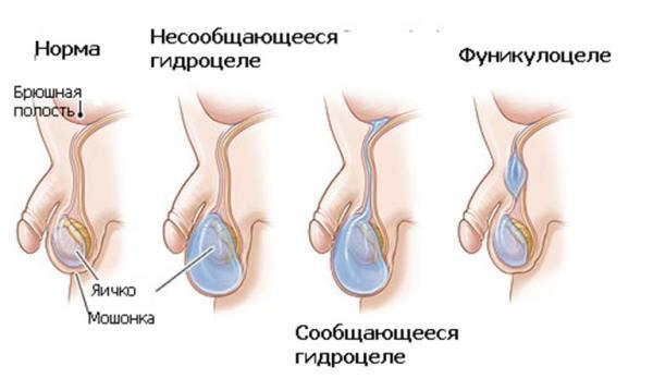 Фуникулоцеле у детей и мужчин: что это, симптомы и лечение кисты семенного канатика