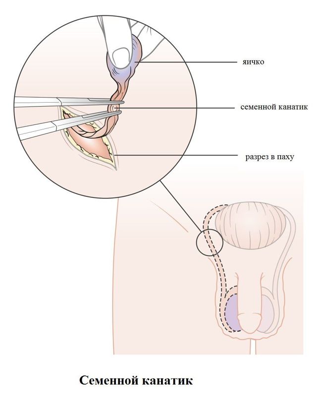 Фуникулоцеле у детей и мужчин: что это, симптомы и лечение кисты семенного канатика
