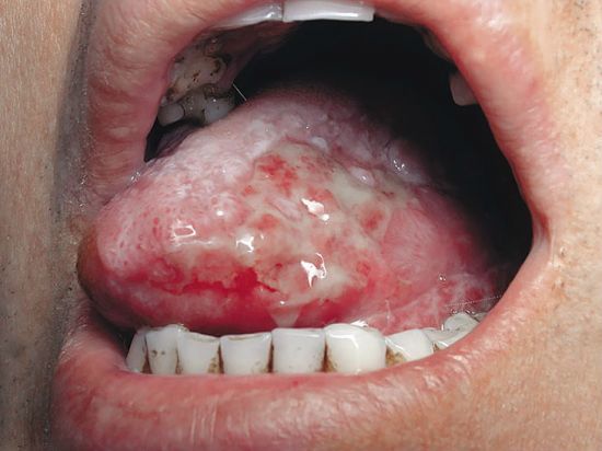 Гальваноз полости рта: причины возникновения, сопутствующие симптомы, тактика лечения и профилактика