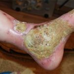 Гангренозная пиодермия на руках и ногах: факторы риска развития, типичные симптомы, диагностика и методы терапии