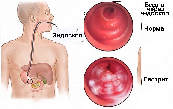 Гастрит с повышенной кислотностью желудка: симптомы, лечение медикаментами и народными средствами