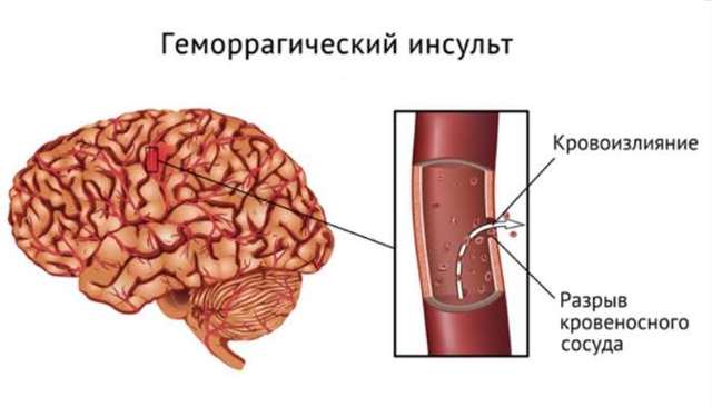 Геморрагический инсульт головного мозга: факторы риска развития заболевания, характерные признаки, тактика лечения и возможные последствия