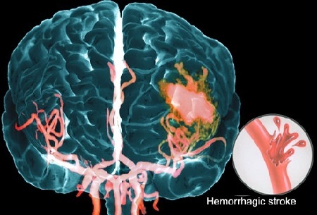 Геморрагический инсульт головного мозга: факторы риска развития заболевания, характерные признаки, тактика лечения и возможные последствия