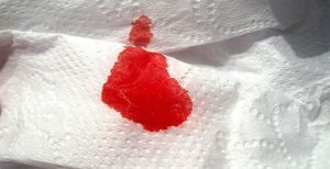 Геморроидальное кровотечение: причины появления, первая помощь, диагностика и методы терапии