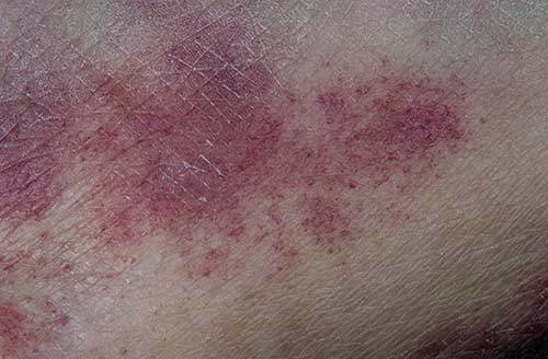 Гемосидероз кожи ног, тела: описание болезни Шамберга, диагностика, традиционные и народные методы терапии
